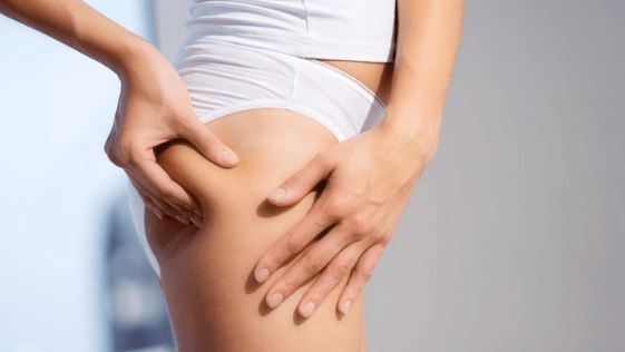 How to Dermaroller Cellulite with Fast Results